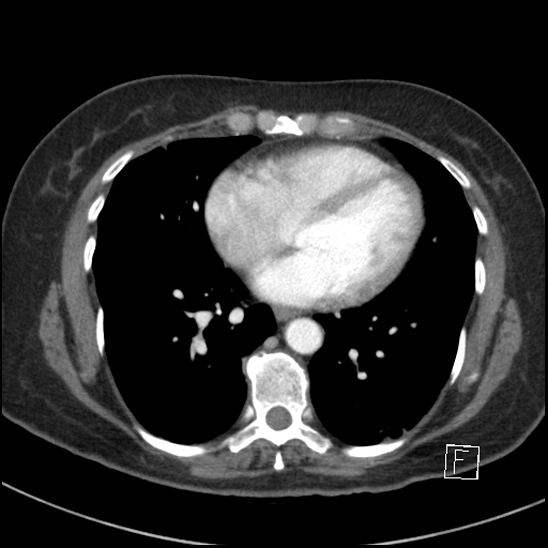 Breast metastases from renal cell cancer (Radiopaedia 79220-92225 A 59).jpg