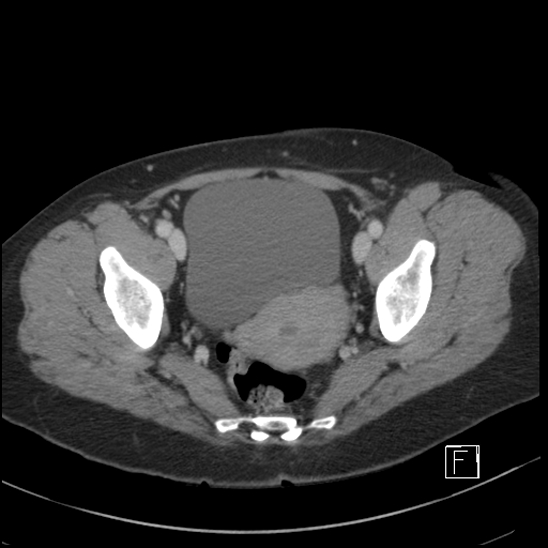File:Breast metastases from renal cell cancer (Radiopaedia 79220-92225 C 103).jpg