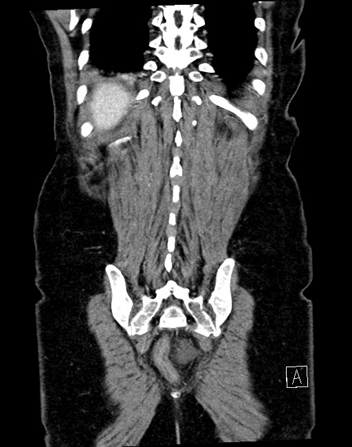 Broad ligament hernia (Radiopaedia 84802-100276 B 4).jpg