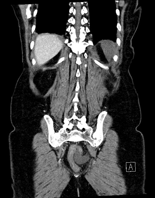 Broad ligament hernia (Radiopaedia 84802-100276 B 7).jpg
