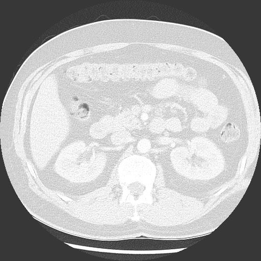 Bronchial carcinoid tumor (Radiopaedia 67377-76764 Axial lung window 72).jpg