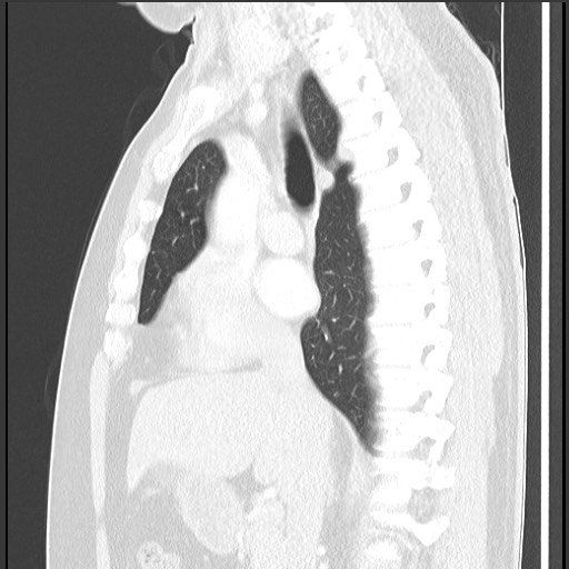 File:Bronchial carcinoid tumor (Radiopaedia 67377-76764 Sagittal lung window 32).jpg