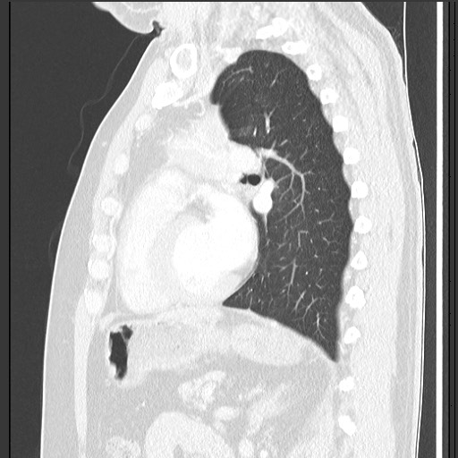 Bronchial carcinoid tumor (Radiopaedia 67377-76764 Sagittal lung window 43).jpg
