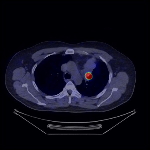 Bronchial carcinoid tumor (Radiopaedia 67377-76765 68Ga-DOTATATE PET-CT 26).jpg