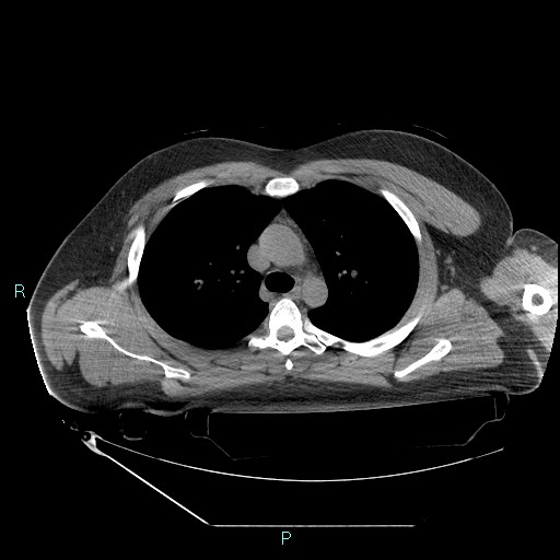 File:Bronchial carcinoid tumor (Radiopaedia 78272-90870 Axial non-contrast 34).jpg