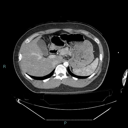 File:Bronchial carcinoid tumor (Radiopaedia 78272-90870 B 118).jpg