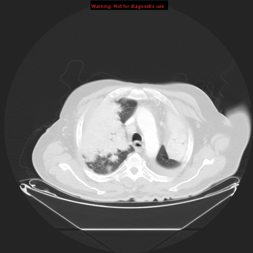 File:Bronchioloalveolar carcinoma (Radiopaedia 9272-9955 Axial lung window 8).jpg