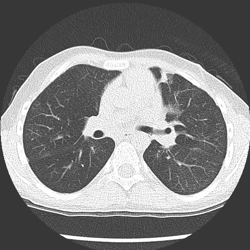 Bronchiolotis obliterans (Radiopaedia 73769-84575 Axial lung window 22).jpg