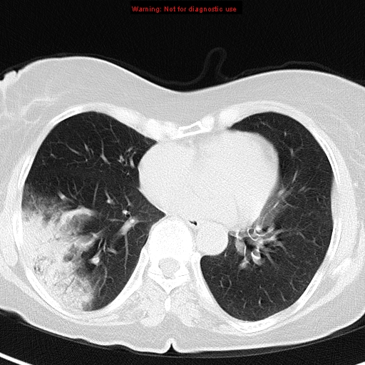 File:Bronchoalveolar carcinoma (BAC) (Radiopaedia 13436-13392 Axial lung window 32).jpg