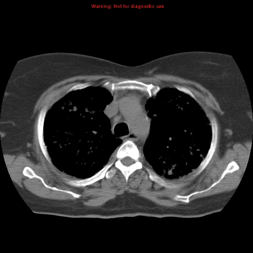 Bronchoalveolar carcinoma (Radiopaedia 13224-13233 Axial non-contrast 14).jpg