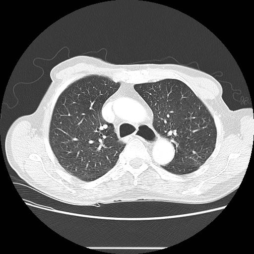 Bronchocele (Radiopaedia 17097-16795 Axial lung window 38).jpg