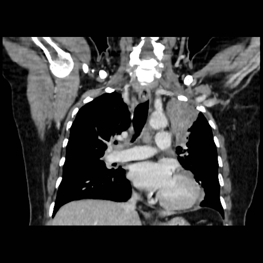 Bronchogenic carcinoma (Radiopaedia 73497-84262 C 67).jpg