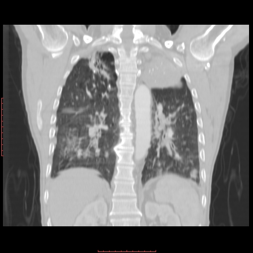 File:Bronchogenic carcinoma with left atrial large deposit - T4N3M1a (Radiopaedia 42316-45428 Coronal lung window 12).jpg