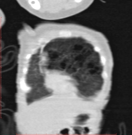 Bronchogenic cyst (Radiopaedia 78599-91409 Coronal lung window 35).jpg