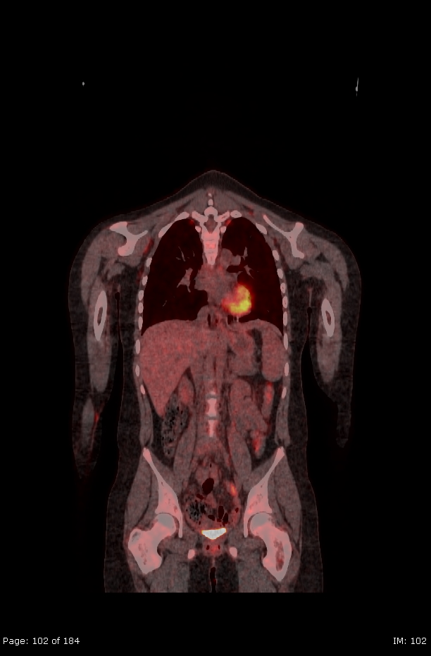 Brown fat uptake (FDG PET-CT) (Radiopaedia 77392-89513 Fused coronal 60).jpg