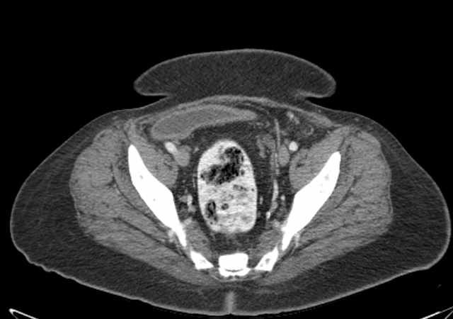 Brown tumors compressing the spinal cord (Radiopaedia 68442-77988 E 105).jpg