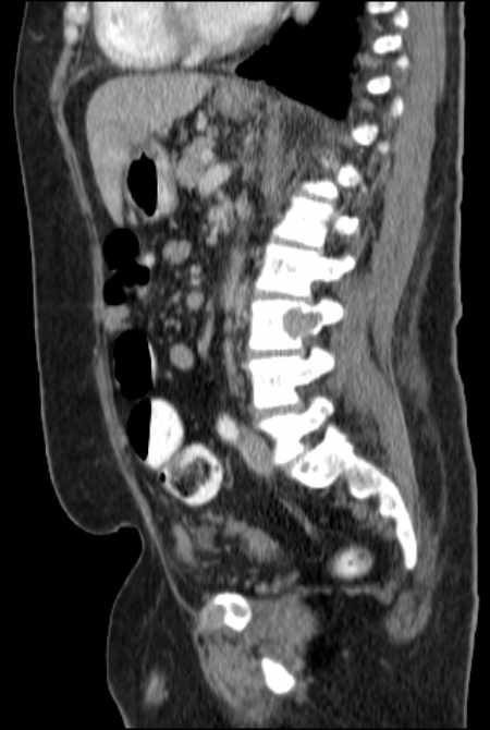 Brown tumors compressing the spinal cord (Radiopaedia 68442-77988 F 33).jpg