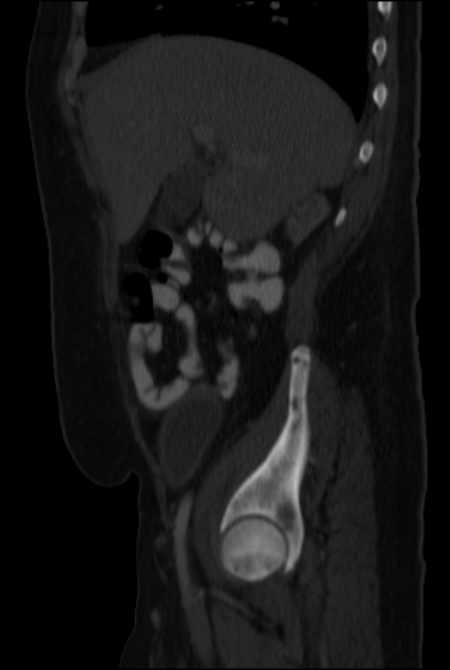 Brown tumors compressing the spinal cord (Radiopaedia 68442-77988 H 17).jpg