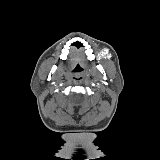 Buccal fat pad arteriovenous malformation (Radiopaedia 70936-81144 D 198).jpg