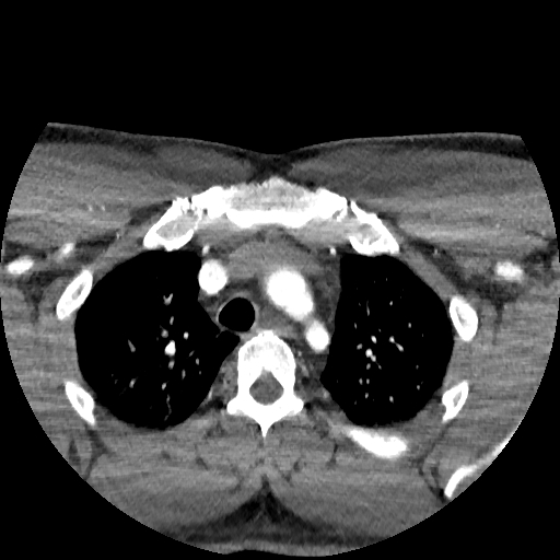 Buccal fat pad arteriovenous malformation (Radiopaedia 70936-81144 D 2).jpg