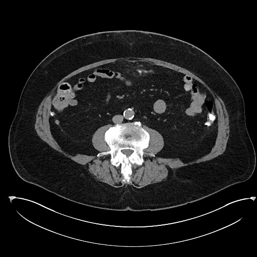 Buried bumper syndrome - gastrostomy tube (Radiopaedia 63843-72577 Axial Inject 66).jpg