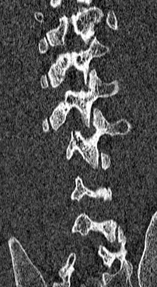Burst fracture (Radiopaedia 53373-59357 Coronal bone window 62).jpg