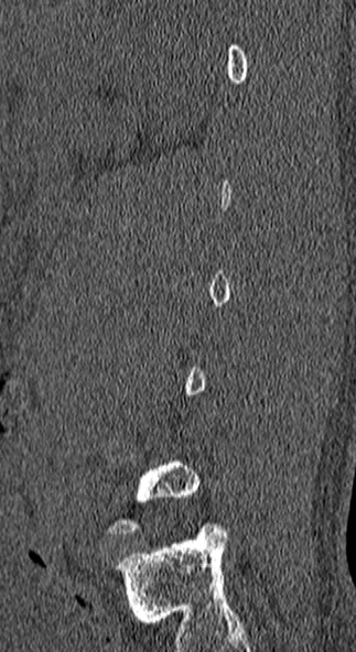 Burst fracture (Radiopaedia 53373-59357 Sagittal bone window 72).jpg