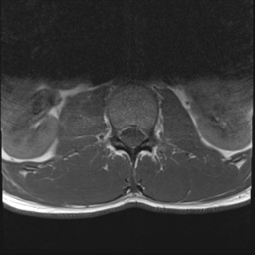 File:Burst fracture - T12 with conus compression (Radiopaedia 56825-63646 Axial T1 6).png