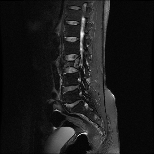 File:Burst fracture - lumbar spine (Radiopaedia 72877-83541 Sagittal STIR 3).jpg
