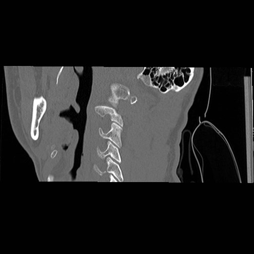 File:C1-C2 "subluxation" - normal cervical anatomy at maximum head rotation (Radiopaedia 42483-45607 C 52).jpg
