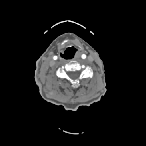 C2 fracture with vertebral artery dissection (Radiopaedia 37378-39200 A 126).png