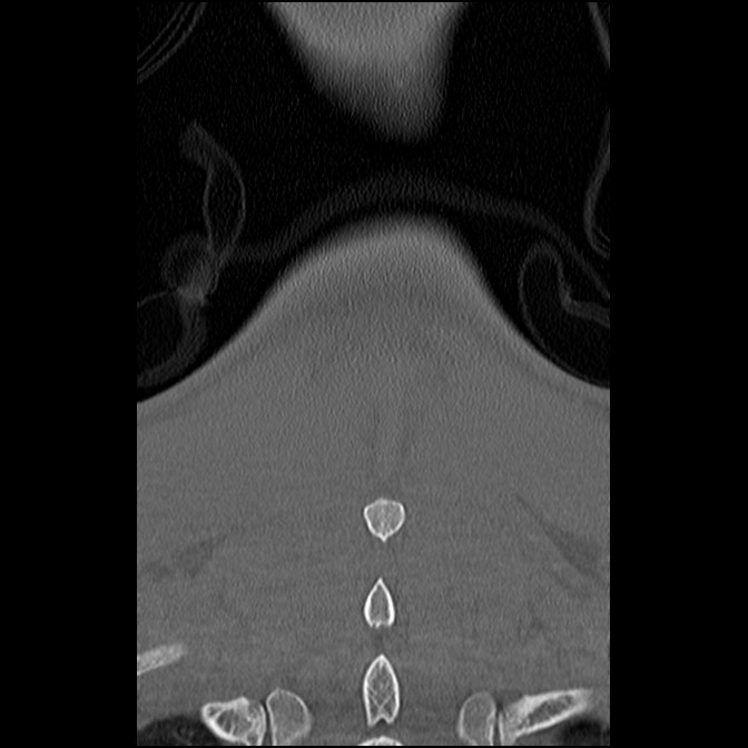 C5 facet fracture (Radiopaedia 58374-65499 Coronal bone window 58).jpg