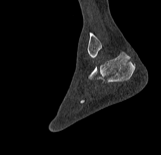 Calcaneal fracture - Sanders type 4 (Radiopaedia 90179-107370 Sagittal bone window 71).jpg