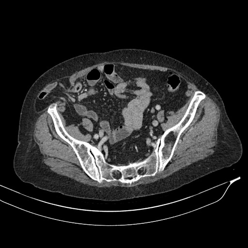 Calcified adrenal glands and Spigelian hernia (Radiopaedia 49741-54988 A 185).jpg
