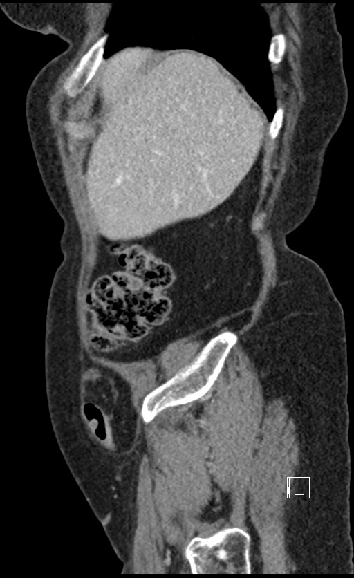 Calcified adrenal glands and Spigelian hernia (Radiopaedia 49741-54988 C 139).jpg