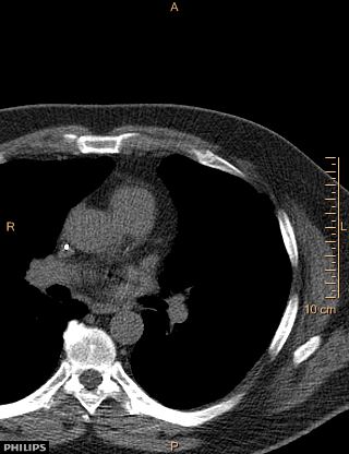 File:Calcified cardiac fibroma (Radiopaedia 39267-41519 Axial non-contrast 4).jpg