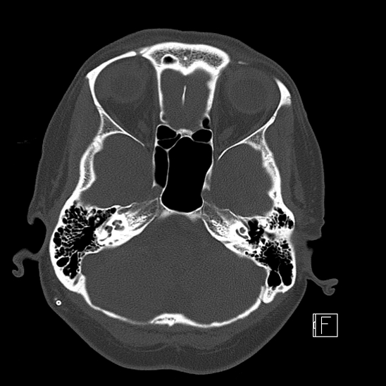 Calcified chronic subdural hematoma (Radiopaedia 77374-89492 Axial bone window 27).jpg