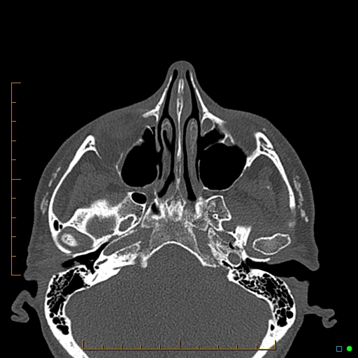Calcified facial augmentation fillers (Radiopaedia 79514-92679 Axial bone window 11).jpg