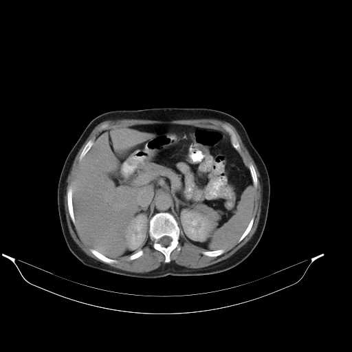 File:Calcified hydatid cyst of the liver (Radiopaedia 21212-21112 Axial C+ delayed 17).jpg
