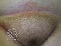 File:Candida vulvovaginitis (DermNet NZ 1311-small).jpg