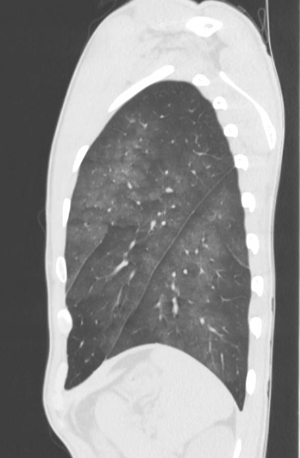 Cannabis-induced diffuse alveolar hemorrhage (Radiopaedia 89834-106946 Sagittal lung window 115).jpg