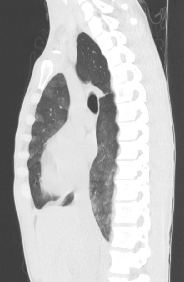 Cannabis-induced diffuse alveolar hemorrhage (Radiopaedia 89834-106946 Sagittal lung window 62).jpg