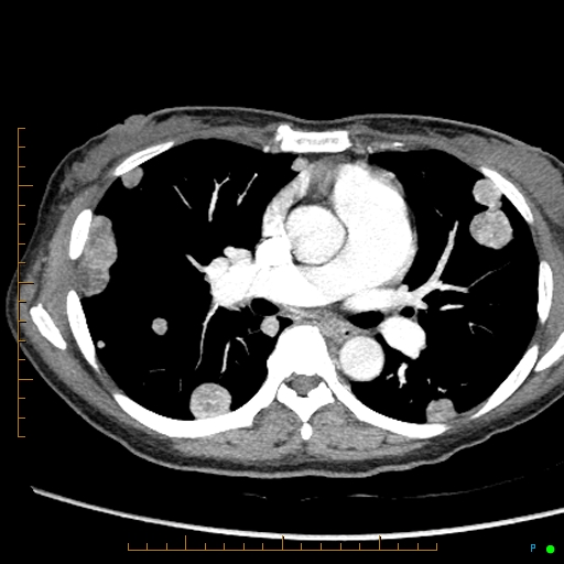 Canonball lung metastasis (Radiopaedia 77634-89837 B 44).jpg
