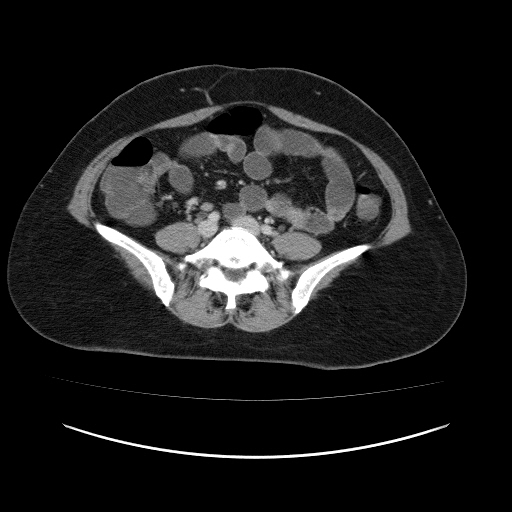 File:Carcinoma colon - hepatic flexure (Radiopaedia 19461-19493 A 85).jpg