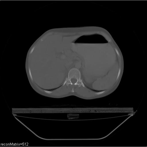 File:Carcinoma of esophagus (Radiopaedia 27356-27550 Axial bone window 2).jpg