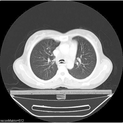 File:Carcinoma of esophagus (Radiopaedia 27356-27550 Axial lung window 22).jpg