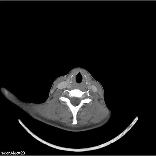 Carcinoma of the maxillary antrum (Radiopaedia 53805-59888 Axial C+ delayed 14).jpg