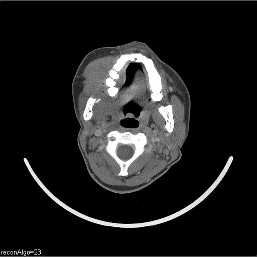 Carcinoma of the maxillary antrum (Radiopaedia 53805-59888 Axial C+ delayed 41).jpg