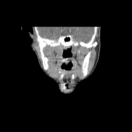 Carcinoma of the maxillary antrum (Radiopaedia 53805-59888 Coronal C+ delayed 79).jpg