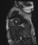 Cardiac amyloidosis (Radiopaedia 51404-57150 Sagittal CINE SSFP 110).jpg